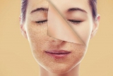 Da mặt bị khô vào mùa đông: Nguyên nhân và cách chăm sóc